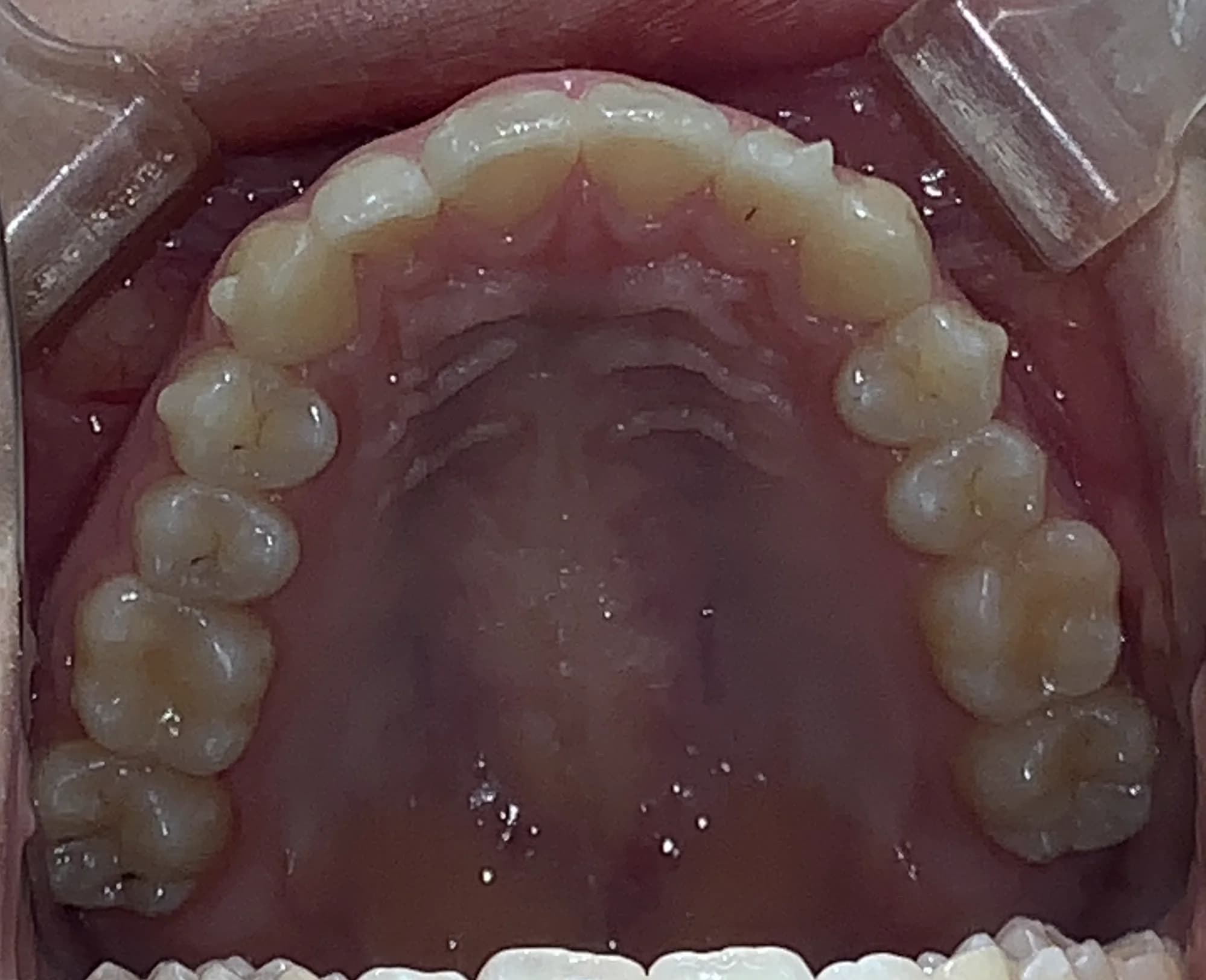 マウスピース矯正 症例2 術後（咬合）